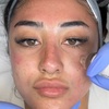 Image 6: Advanced Micro-needling w/ Luxury Hydrating Serums - Face and/or Neck