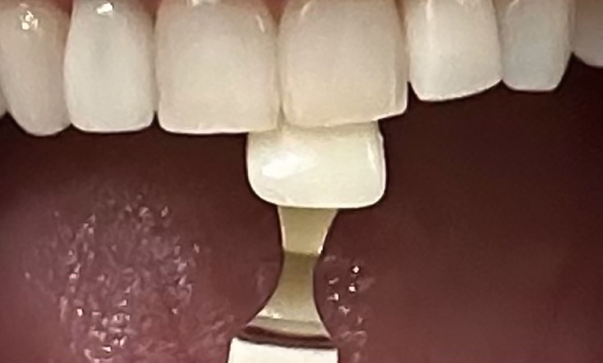 Image 4: Get a Brighter Smile w/ One / Two 30 or 60 min Teeth Whitening Options