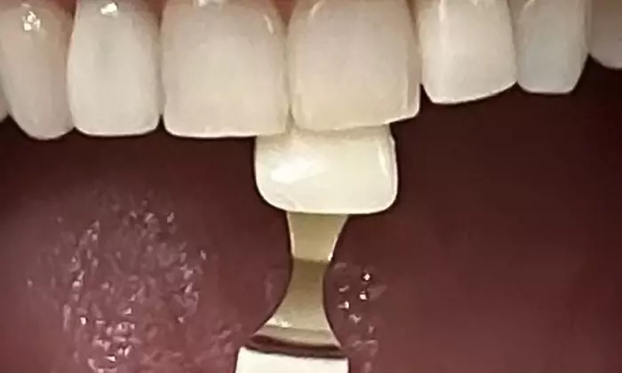 Get a Brighter Smile w/ One / Two 30 or 60 min Teeth Whitening Options