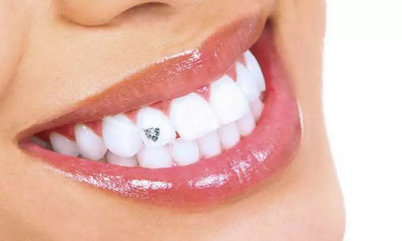 Blanchiment dentaire avec Atelier Beauty