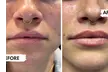Achieve Enhanced Lips with Revanesse Versa (0.6mL) & Revanesse Lips (1.2mL) Dermal Fillers (Up to 56% Off) - Second Medium
