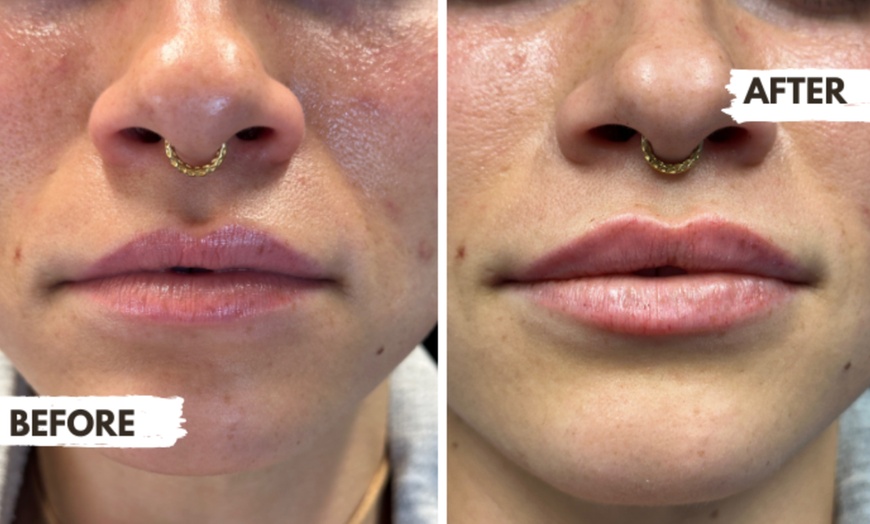 Image 3: Targeted Dermal Filler Treatments: Revanesse Versa & Lips