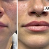 Image 3: Targeted Dermal Filler Treatments: Revanesse Versa & Lips