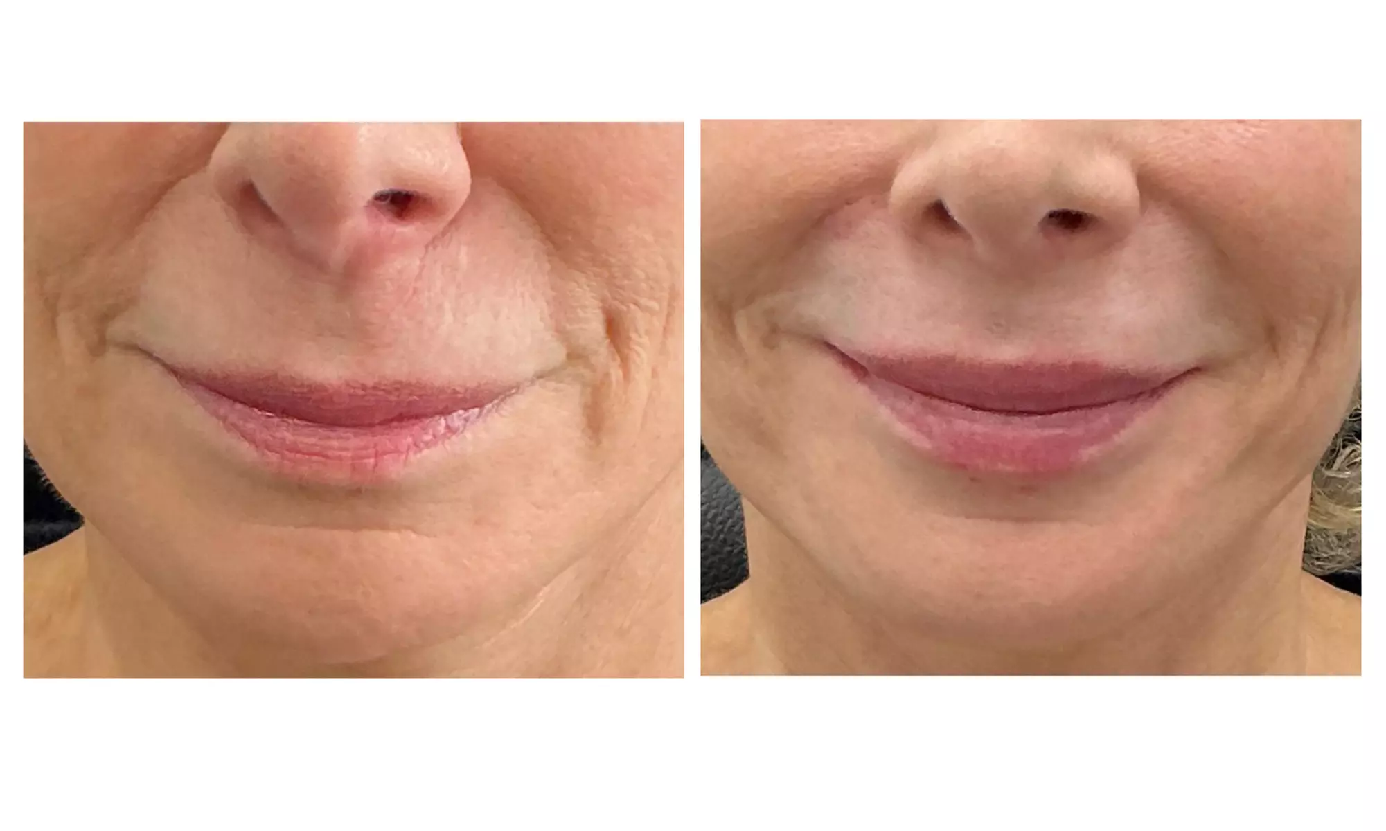 Revitalize w/ MONO Threads Under Eyes, Neck, Partial or Full Face Lift