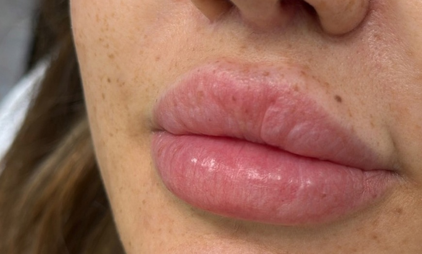Image 2: Enhance w/ 0.5, 1, 2ml Lip Filler or  0.5ml Lip Filler + Smile Lines