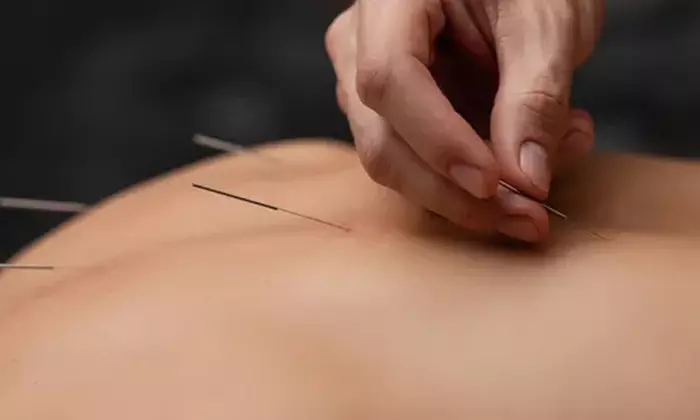 Relieve Aches with  One or Two Acupuncture Sessions with Optional Cuppings @Purple Tree Herbs (Up to 48%
Off) - Second Medium