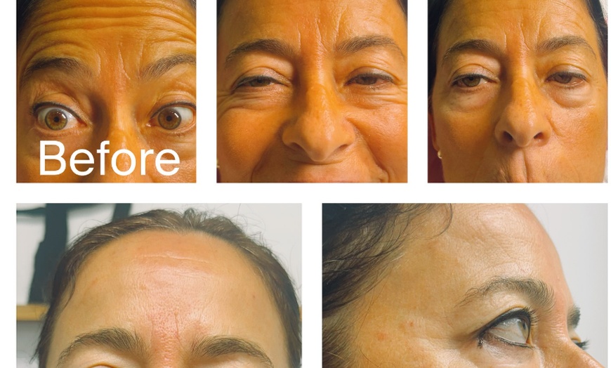 Image 4: Botox Units for Forehead Lines Crow Feet and Full Face Smoothing