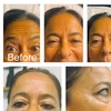 Image 4: Botox Units for Forehead Lines Crow Feet and Full Face Smoothing
