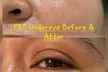 Get 1 or 2 Under Eye PRP with Platelet-Rich Plasma Sess Treatment at K Med Spa And Iv Bar (Up to 46% Off) - Second Medium
