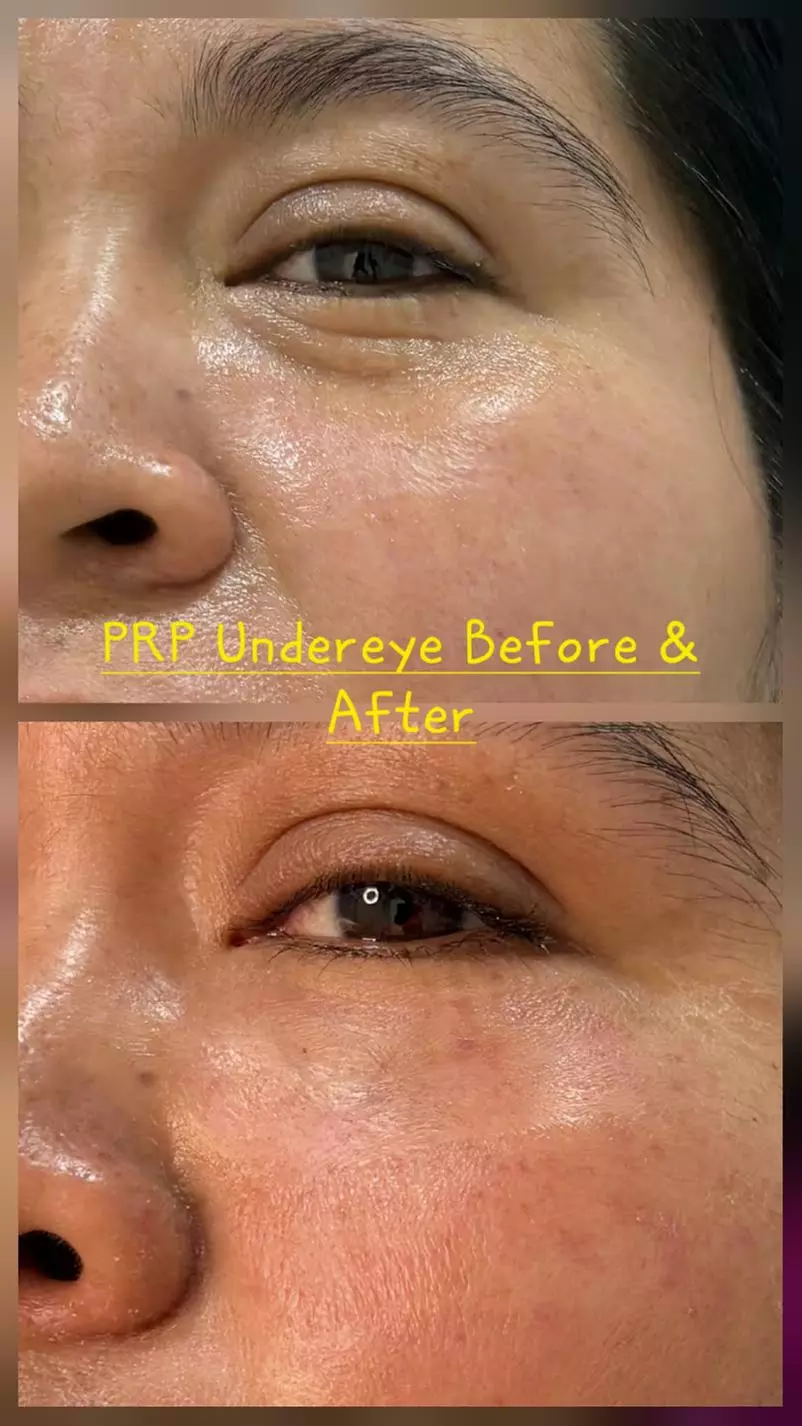 Get 1 or 2 Under Eye PRP with Platelet-Rich Plasma Sess Treatment