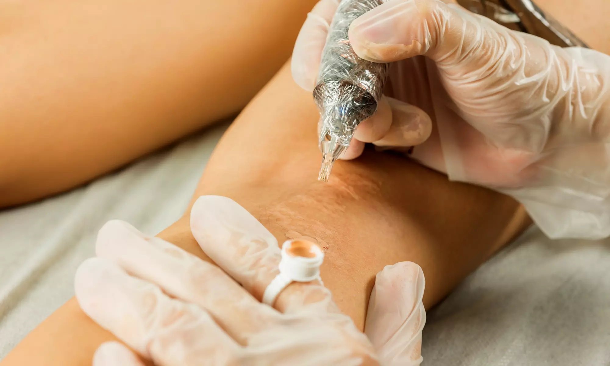 Expert Scar & Stretch Mark Camouflage Tattoo in Salt Lake City