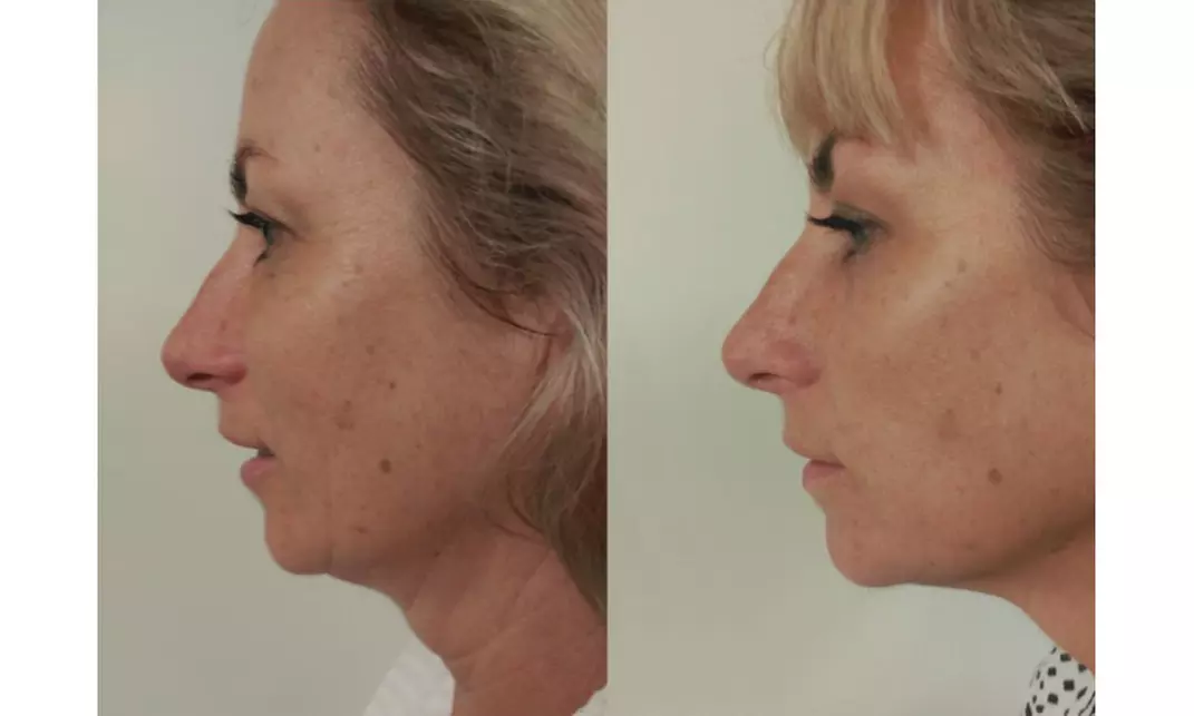 Non-Invasive HIFU Treatments for Crow's Feet, Chin & More