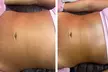 Discover specialized Post-op care ( after lipo/ bbl/ tummy tucks) service at Nenas Beauty Glow Bar - Second Medium