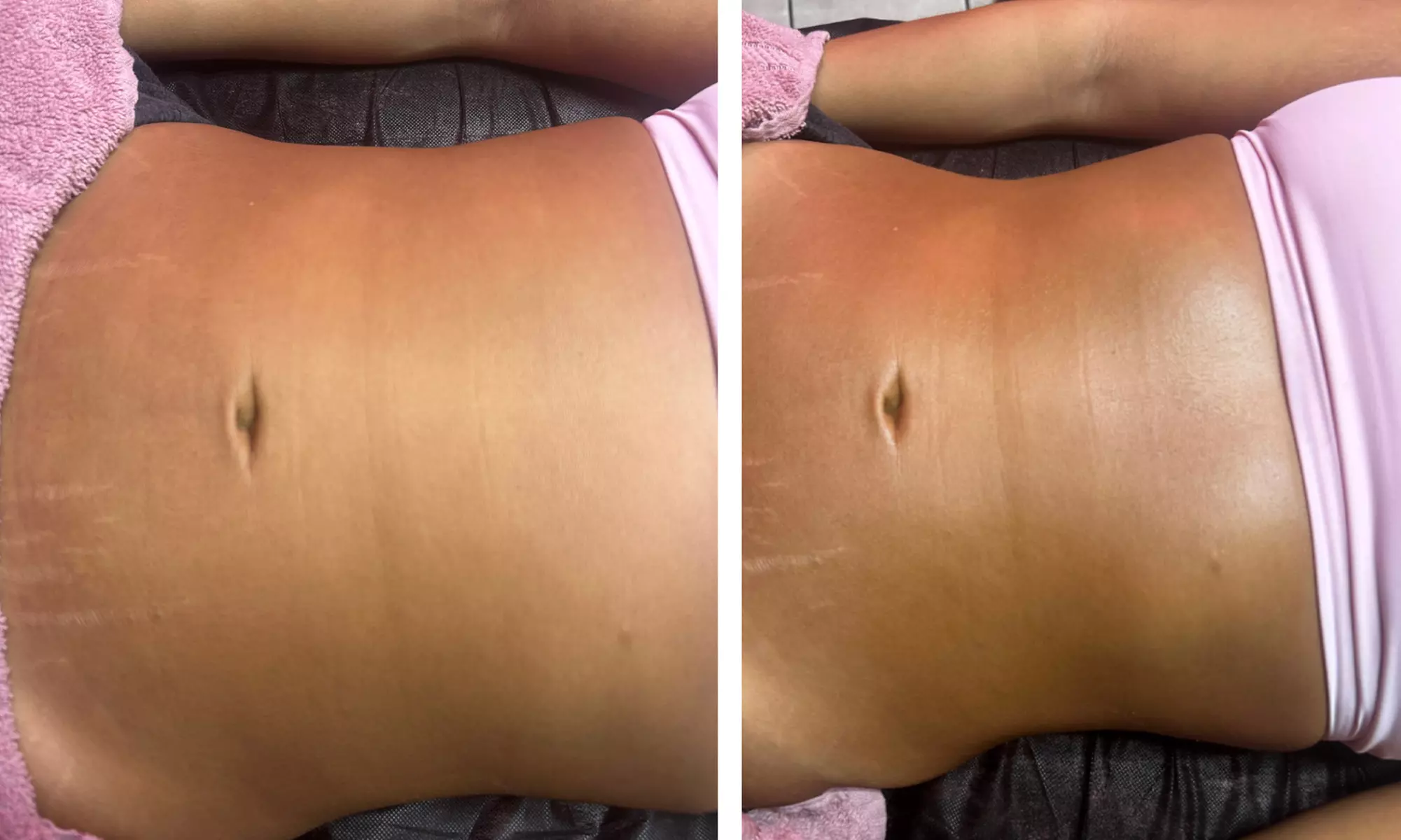 Embrace a comprehensive Post-op care (after lipo/ bbl/ tummy tucks)