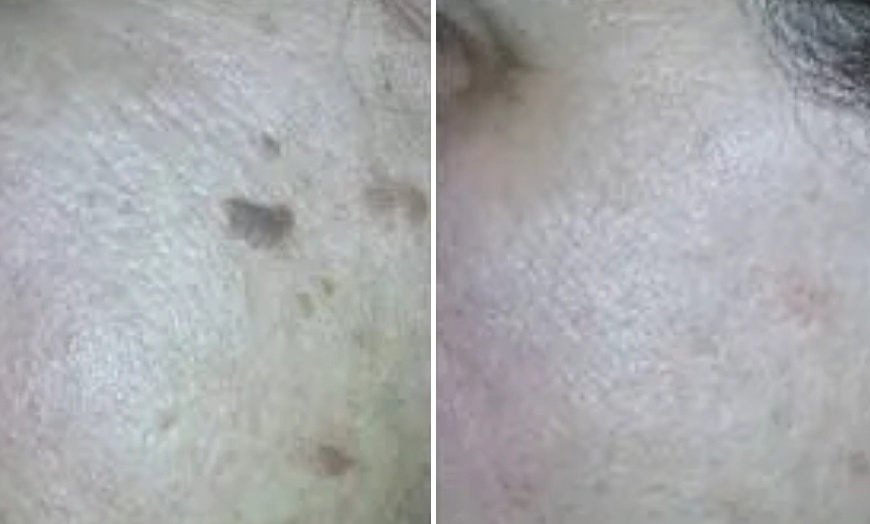 Image 4: Up to 30% Off on Mole / Growth Removal at Sugar'n Sculpt Westlake