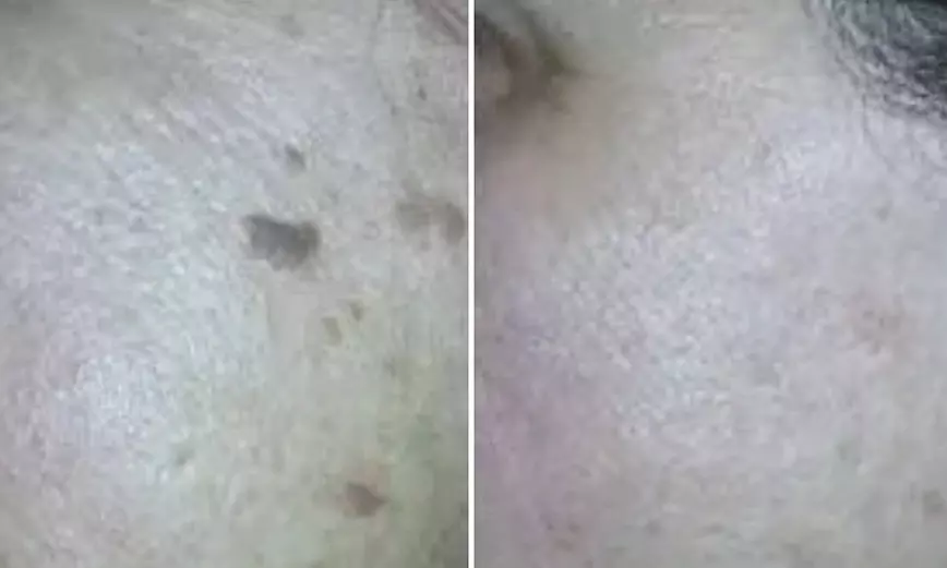 Spotless Skin: Remove 1, 3, or 5 Skin Tags, Age Spots & More 