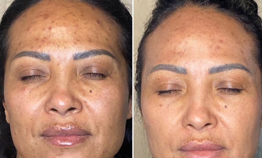 Image 2: Achieve Radiant Skin: Microdermabrasion Facial