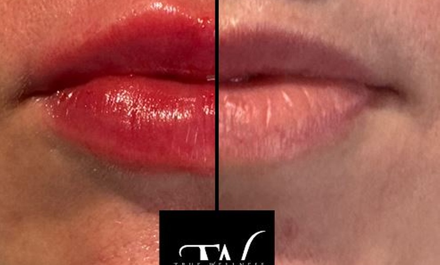 Image 6: Achieve Plump Lips with 1ml or 2ml Dermal Fillers  