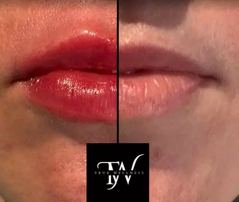 Achieve Plump Lips with 1ml or 2ml Dermal Fillers  