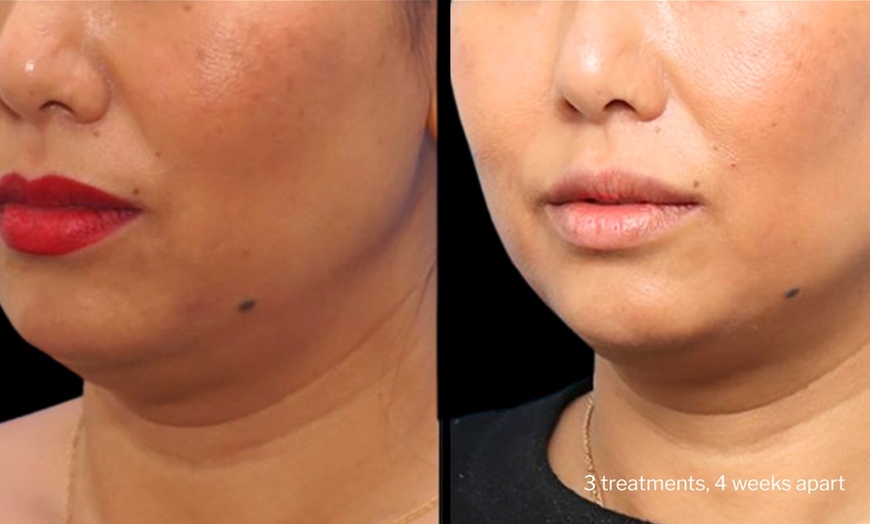 Image 8: Morpheus8 Non-surgical Tightening - Allure Passions Aesthetic Clinic
