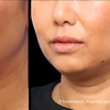 Image 8: Morpheus8 Non-surgical Tightening - Allure Passions Aesthetic Clinic