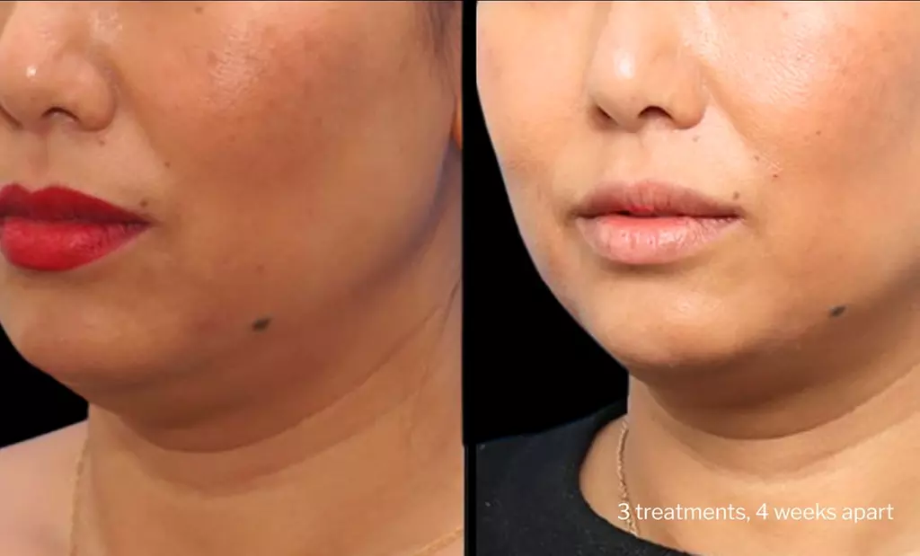 Morpheus8 Non-surgical Tightening - Allure Passions Aesthetic Clinic