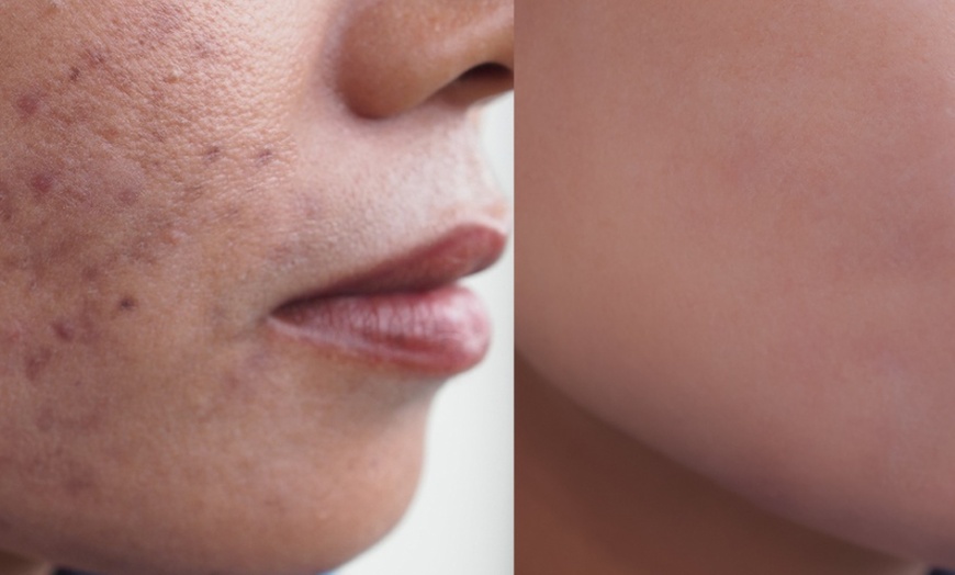 Image 2: 1 oder 2x 60 Min. Radiofrequenz-Microneedling inkl. Seren für 1 Person