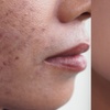 Image 2: 1 oder 2x 60 Min. Radiofrequenz-Microneedling inkl. Seren für 1 Person