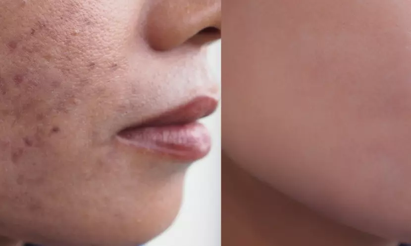 1 oder 2x 60 Min. Radiofrequenz-Microneedling inkl. Seren für 1 Person