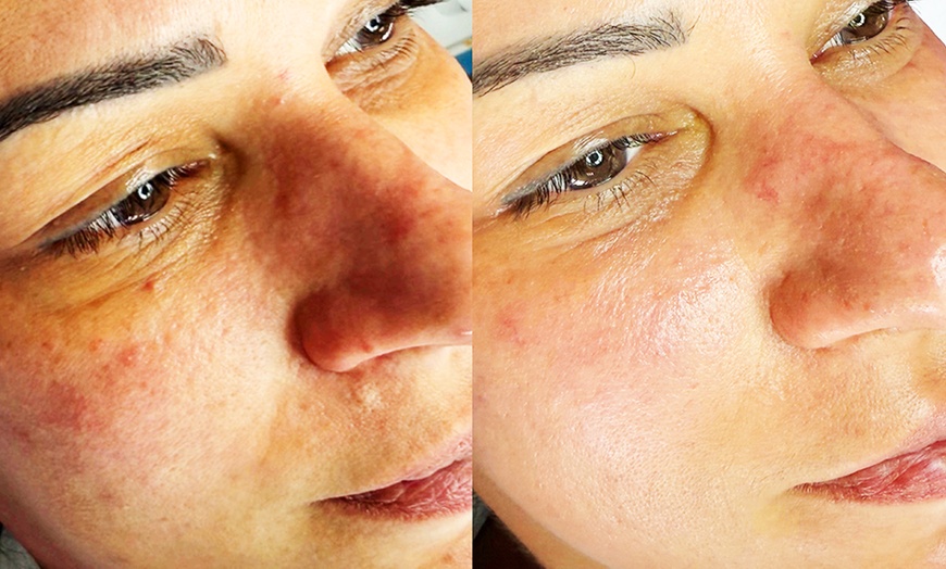 Image 2: Aqua-Facial, Microneedling, Wimpern- / Augenbrauen-Lifiting für 1 P.