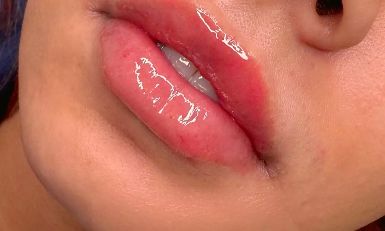 50 or 100 Units of Xeomin with Optional 1.2ml Syringe of Versa