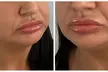 1ml or 2ml Dermal Lip Filler with Consultation at 4 Locations including Harley Street (Up to 74% Off) - Second Medium