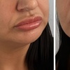 Image 6: 1ml or 2ml Dermal Filler Treatment on Lips with Consultation