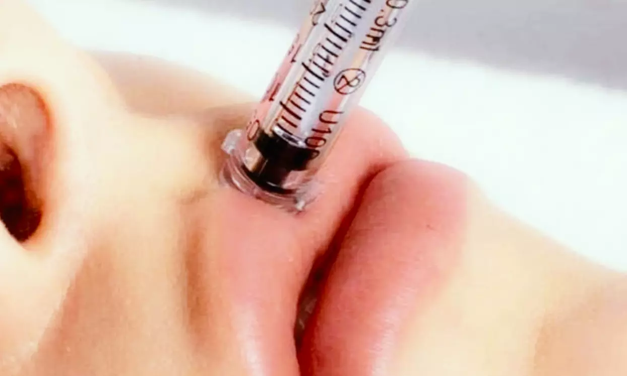 Get 1 or 2 ml of Lip Filler with Needle-Less Application