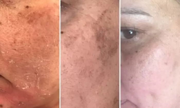 Transform Your Skin w/ One, Three, or Six 60-Min IPL Facial Sessions