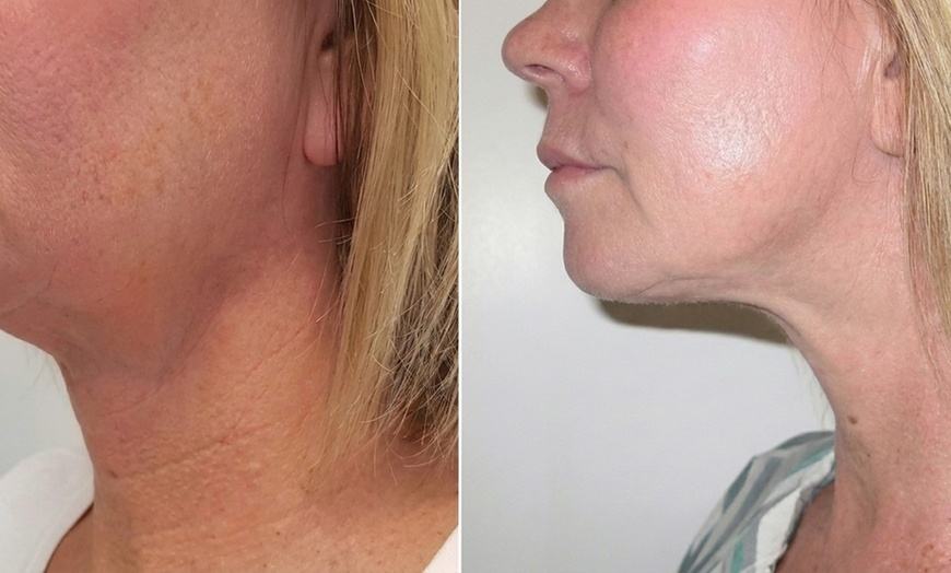 Image 4: Botox Treatments for Forehead, Crow Feet, Lip Flip, or Jawline Areas
