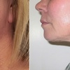 Image 4: Botox Treatments for Forehead, Crow Feet, Lip Flip, or Jawline Areas