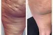 Up to 78% Off on Cryotherapy - Cryosurgery at Skin Memoirs by Arianna Nesbeth - Second Medium