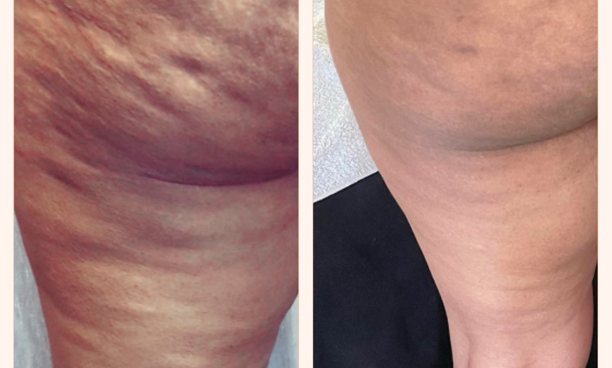 Image 6: Up to 78% Off on Cryotherapy - Cryosurgery at Skin Memoirs by Arianna Nesbeth