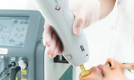 One Laser Genesis Treatment on the Face with Candela GentleMax Pro - The Laser Queen MD Beauty Studio in Hallandale