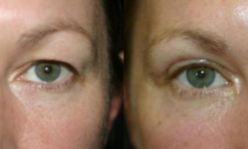 Image 4: Reveal Brighter, Younger-Looking Eyes with Eyelid Surgery