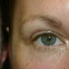 Image 4: Reveal Brighter, Younger-Looking Eyes with Eyelid Surgery
