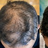 Image 1: Scalp Micropigmentation Consultation + Mapping or Spot Coverage 