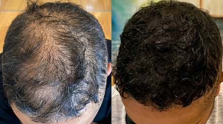 Scalp Micropigmentation Consultation With Mapping, Style Design, Treatment Plan, and Finance Options - Eyebrows and More LLC
