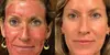 PRP Facial Treatment + Microneedling (Up to 84% Off) with Sunday-Only Appointments