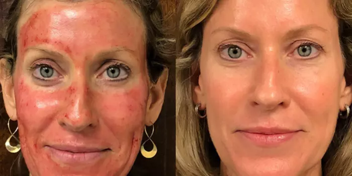 PRP Facial Treatment + Microneedling (Up to 84% Off) with Sunday-Only Appointments - Primary Image