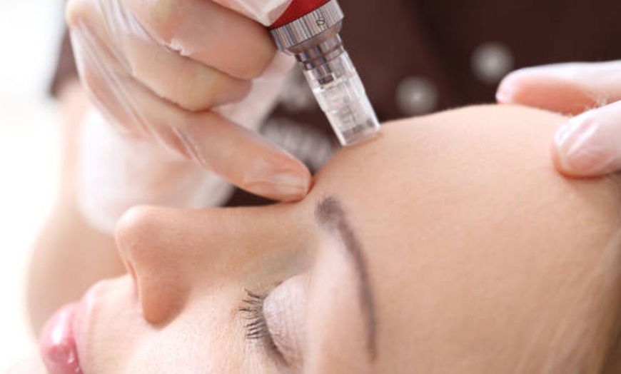 Image 7: Hyaluronpen con hidratación o relleno de labios y reafirmación facial