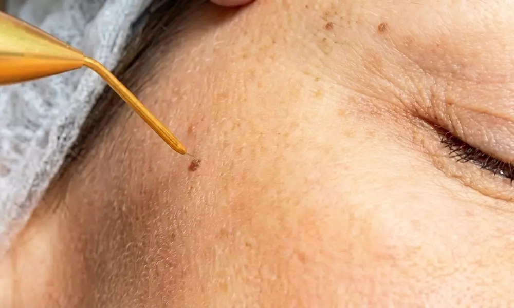 1 o 2 sesiones de plasma pen en zona a elegir para 1 persona