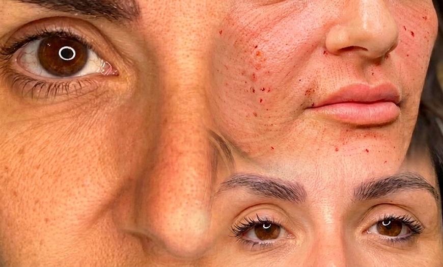 Image 2: 1 o 2 sesiones de fibroblast con plasma pen facial completo para 1