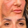 Image 2: 1 o 2 sesiones de fibroblast con plasma pen facial completo para 1